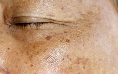 你不知道的祛斑消痘印小竅門，方便又省錢