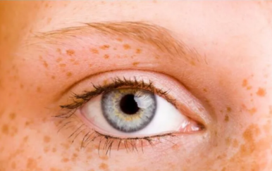 女人黃褐斑是怎么形成的？主要與這幾大因素有關(guān)