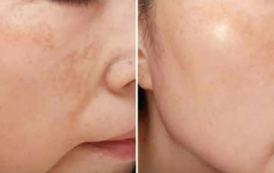 都說祛斑難，對不起，那是他因為你沒選對方法！